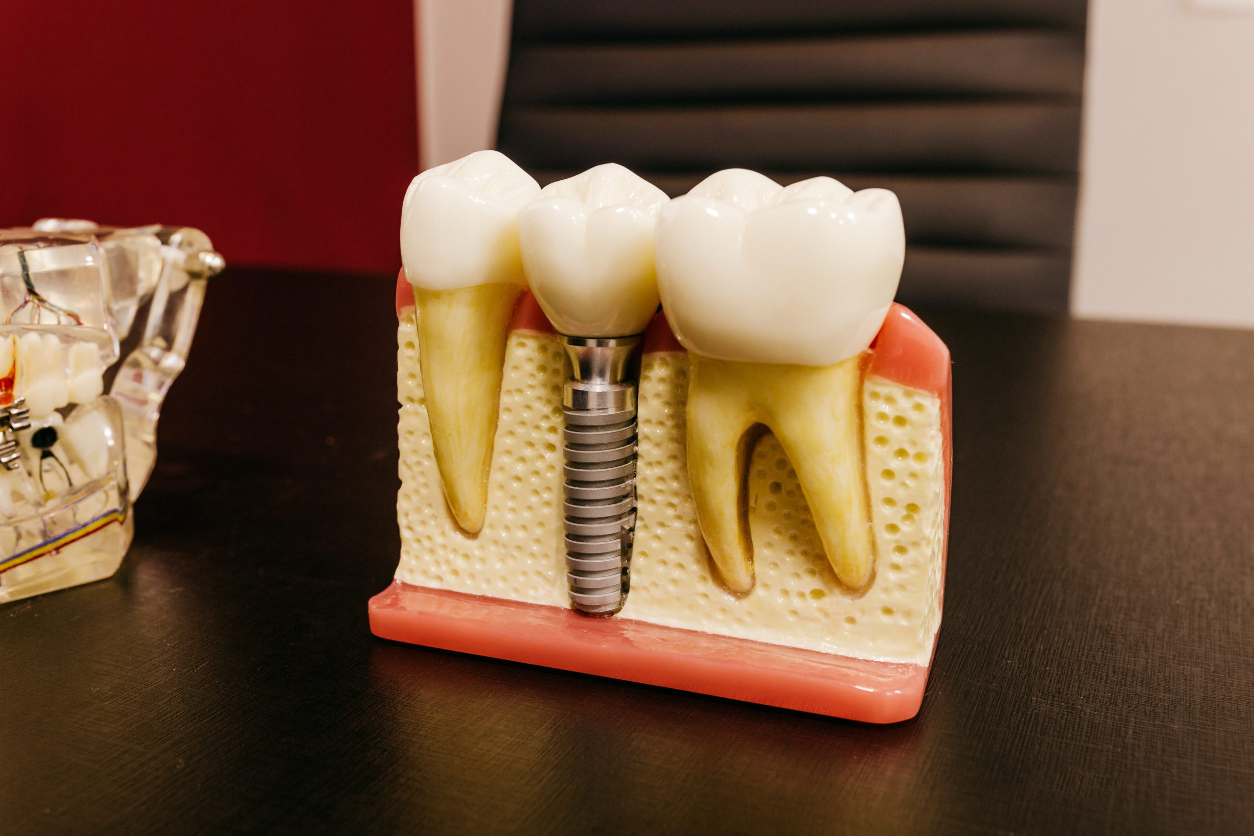 Dental Implants For Seniors
